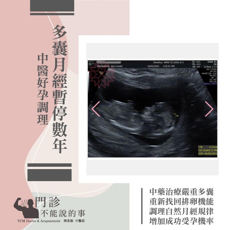 多囊月經暫停數年中醫調理好孕到－封面圖